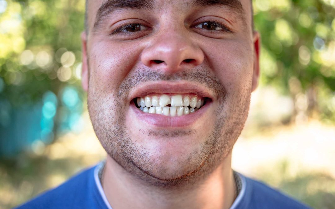 Chipped or Cracked Teeth: Causes and Repair Options