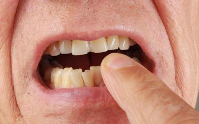 Chipped or Cracked Teeth: Understanding Causes and Exploring Repair Options at Centrasota Dental