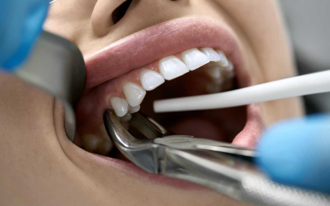 What is a Full Mouth Reconstruction? A Step-by-Step Guide to Restoring Your Smile