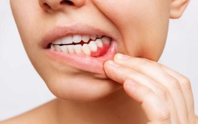 Gum Disease: Causes, Symptoms, and Treatment