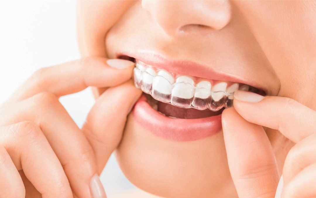 Invisalign vs. Traditional Braces: Which Is the Right Choice for Your Smile Transformation?