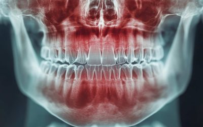 Oral Cancer Awareness: Early Detection Saves Lives