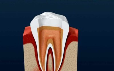 Root Canal Therapy; What To Expect