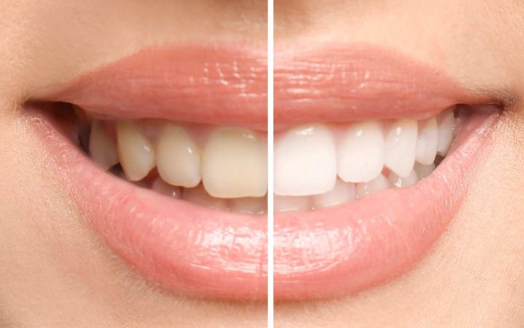 Teeth Whitening for Sensitive Teeth: Finding a Brighter Smile Without Discomfort