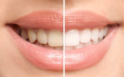 Teeth Whitening for Sensitive Teeth: Finding a Brighter Smile Without Discomfort