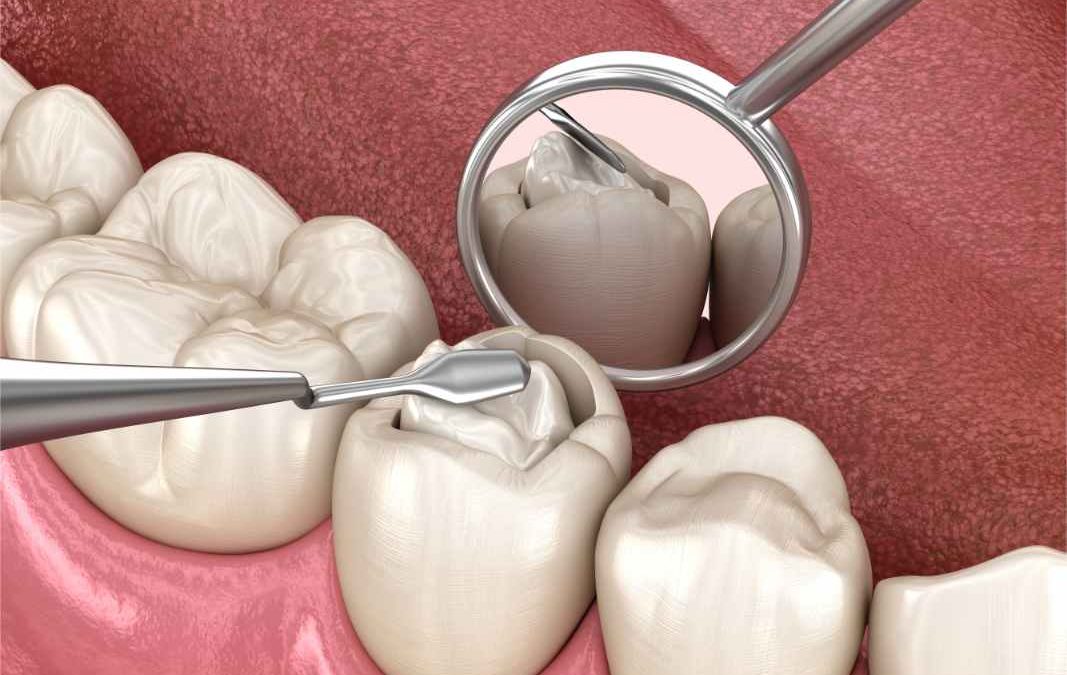St. Cloud’s Defense Against Cavities: A Comprehensive Guide to Preventing and Treating Tooth Decay