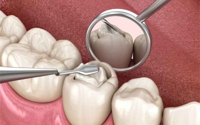 St. Cloud’s Defense Against Cavities: A Comprehensive Guide to Preventing and Treating Tooth Decay