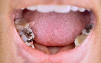Tooth Decay: How to Prevent and Treat Cavities