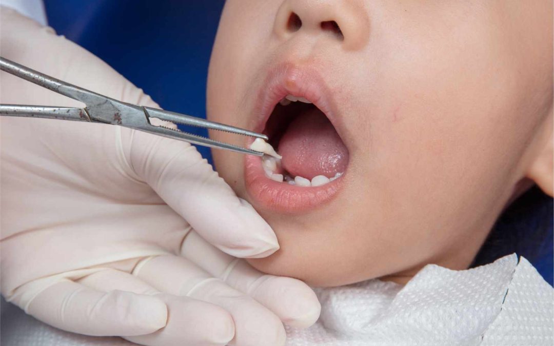 Tooth Extraction Aftercare: Your St. Cloud Guide to Pain Management and Healing