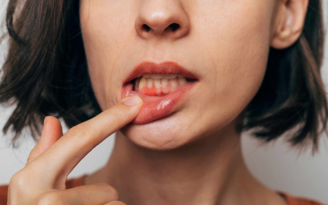 Healthy Gums: The Importance of Deep Cleaning