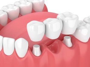 dental bridges at centrasota dental