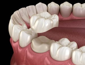 Dental Crowns at Centrasota Dental