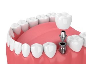 dental implants at centrasota dental