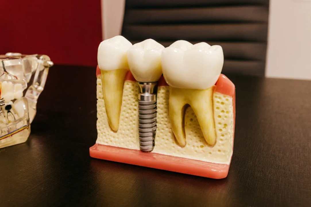 dental implant option