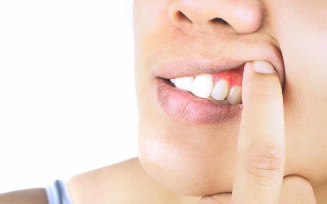 Protect Your Gums in St. Cloud: Understanding Gum Disease – Causes, Symptoms, and Treatment