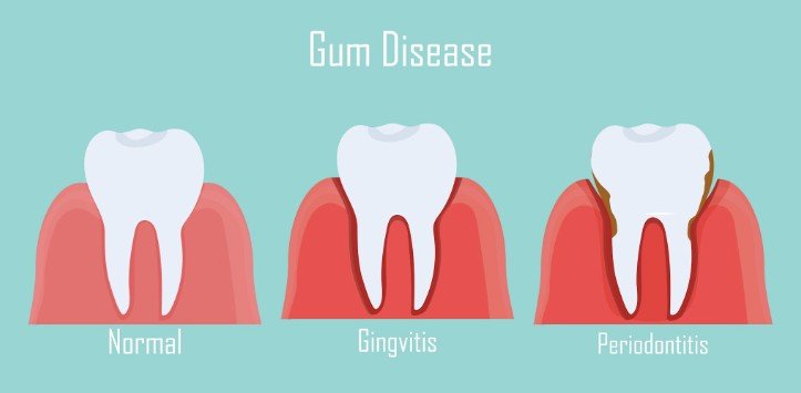Impact on Gum Health and Gingival Inflammation
