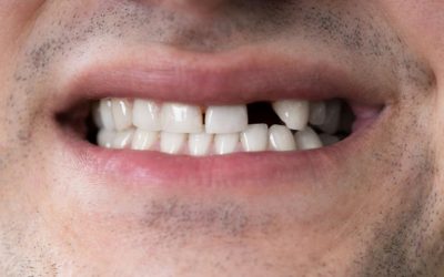 The Benefits of Dental Implants for Replacing Missing Teeth