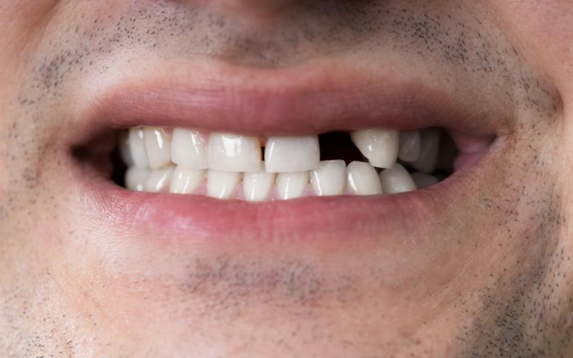 The Benefits of Dental Implants for Replacing Missing Teeth