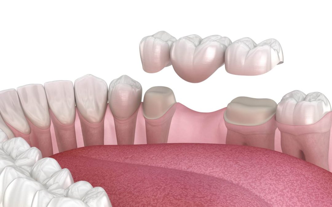 Signs You Might Need a Dental Crown
