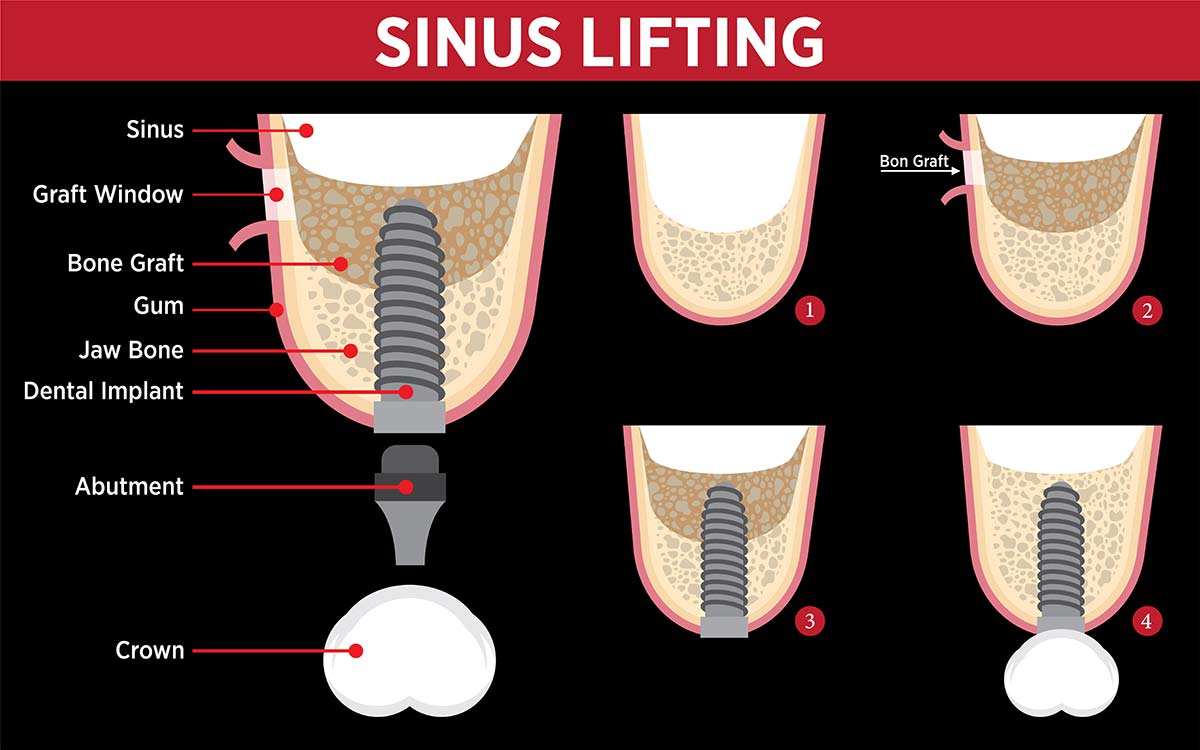 Sinus Lifting