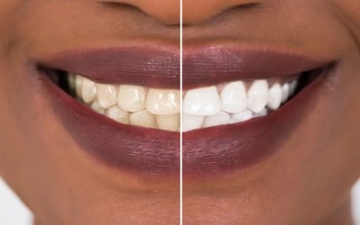 Teeth Whitening; Why To Leave it to the Pros