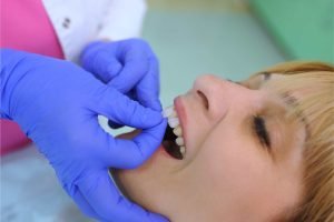 veneers at centrasota dental